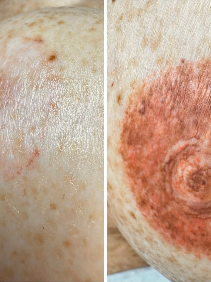 Areola restoration tattoo before and after at Calypso Beauty, Bellevue / Kirkland
