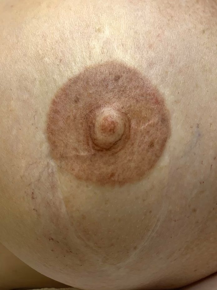 Areola restoration tattoo result at Calypso Beauty, Bellevue / Kirkland