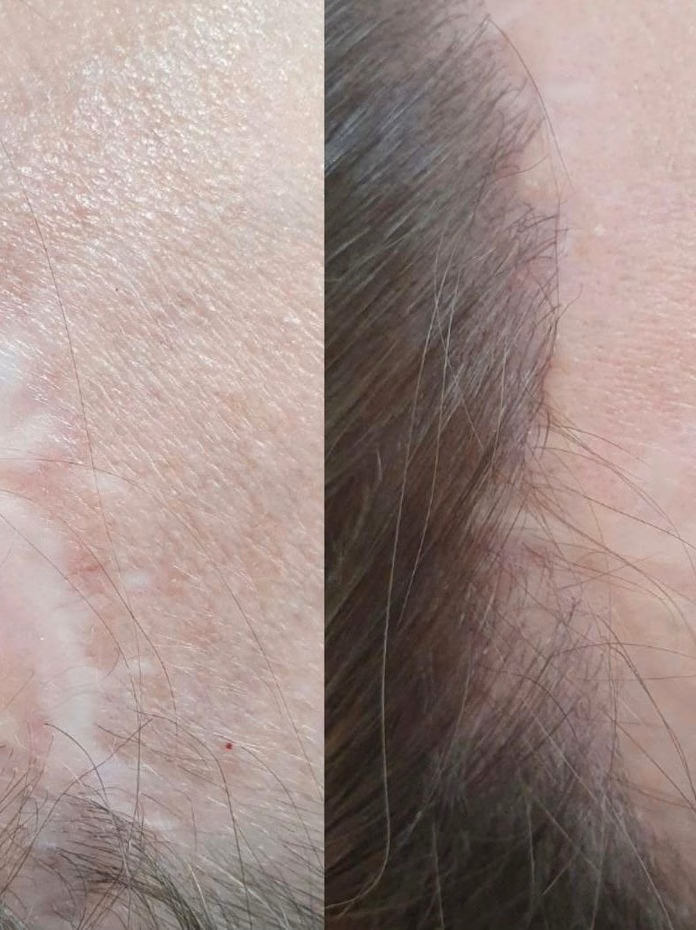 Scalp micropigmentation before and after at Calypso Beauty, Bellevue / Kirkland