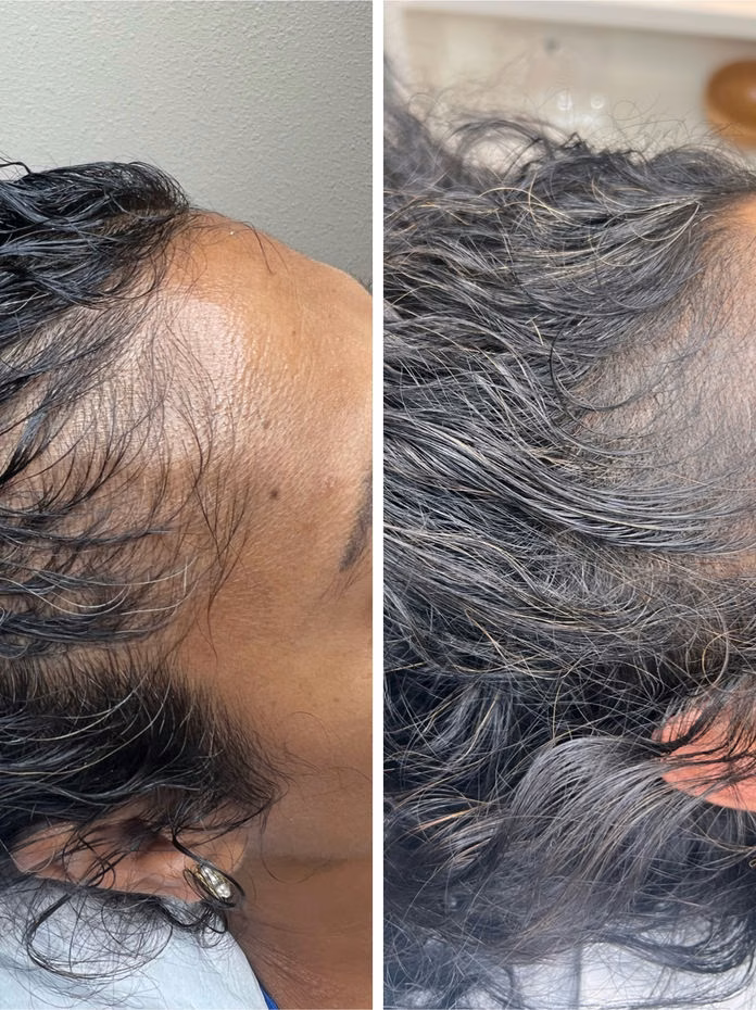 Scalp micropigmentation before and after at Calypso Beauty, Bellevue / Kirkland