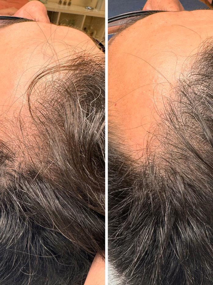 Scalp micropigmentation before and after at Calypso Beauty, Bellevue / Kirkland