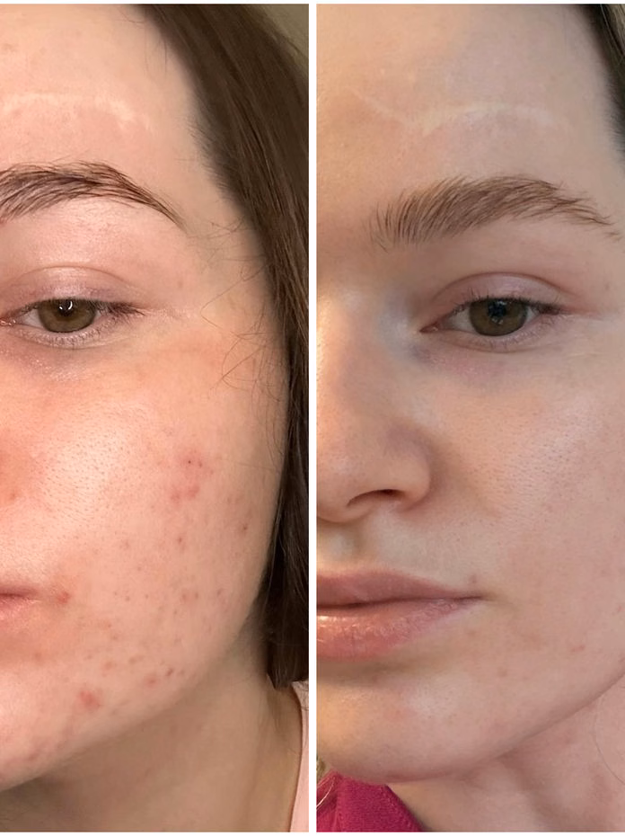 Facial treatment before and after at Calypso Beauty, Bellevue / Kirkland