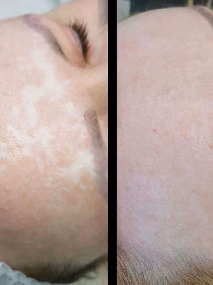 Vitiligo camouflage before and after at Calypso Beauty, Bellevue / Kirkland