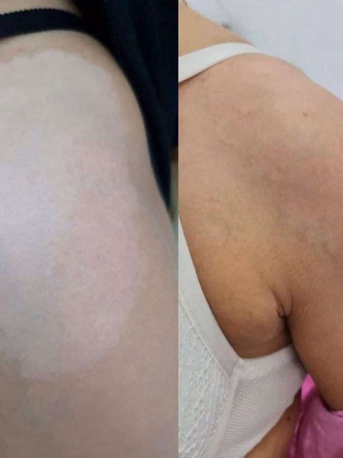 Vitiligo camouflage before and after at Calypso Beauty, Bellevue / Kirkland