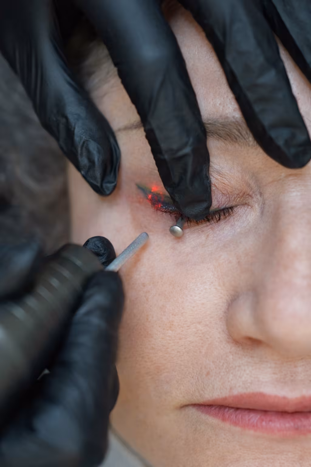 Laser eyeliner tattoo removal session at Calypso Beauty, Bellevue / Kirkland