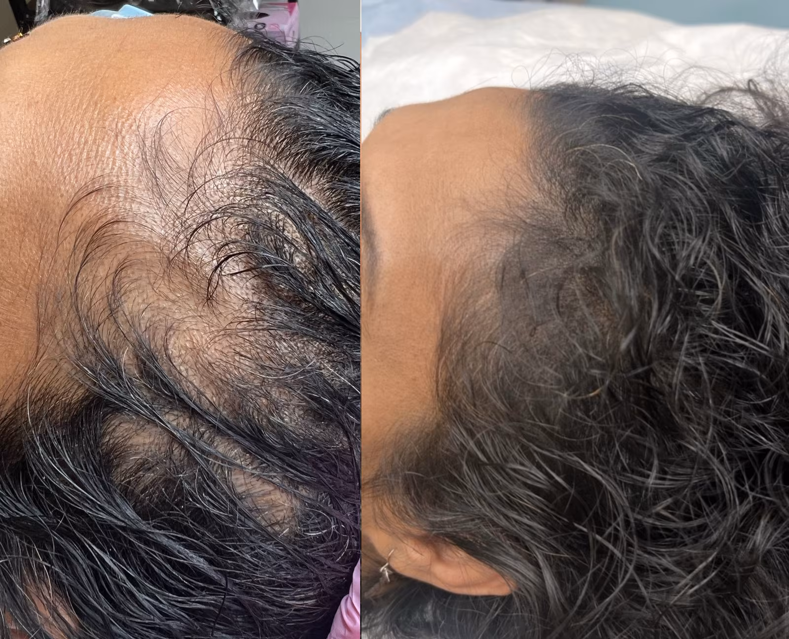 Before and after scalp micropigmentation restoring a receding hairline with replicated hair follicles