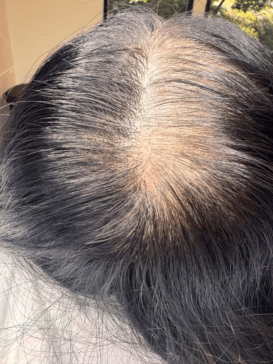 Thinning hair part with visible scalp, the concern scalp micropigmentation addresses
