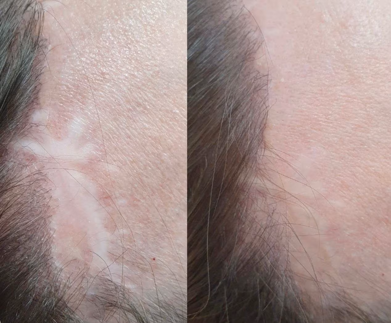 Before and after of scalp scar camouflage with micropigmentation at Calypso Beauty