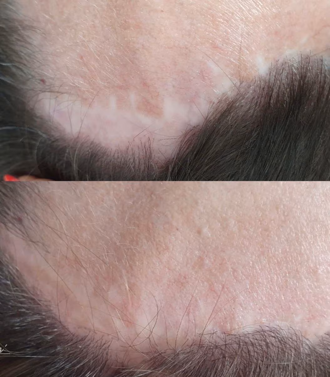Hairline scar camouflage with micropigmentation, before and after