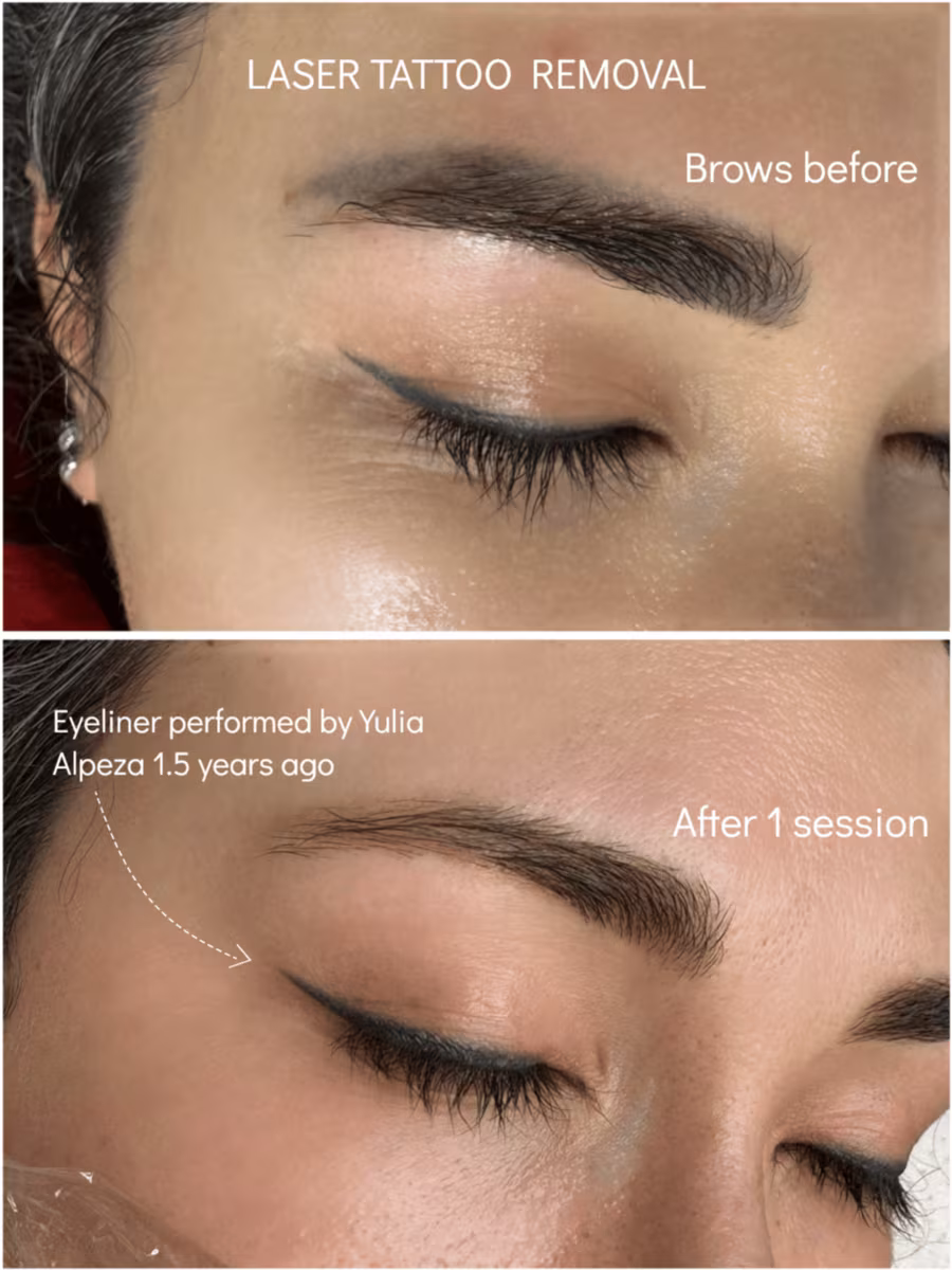 Eyebrow tattoo before and after one laser removal session at Calypso Beauty, Kirkland