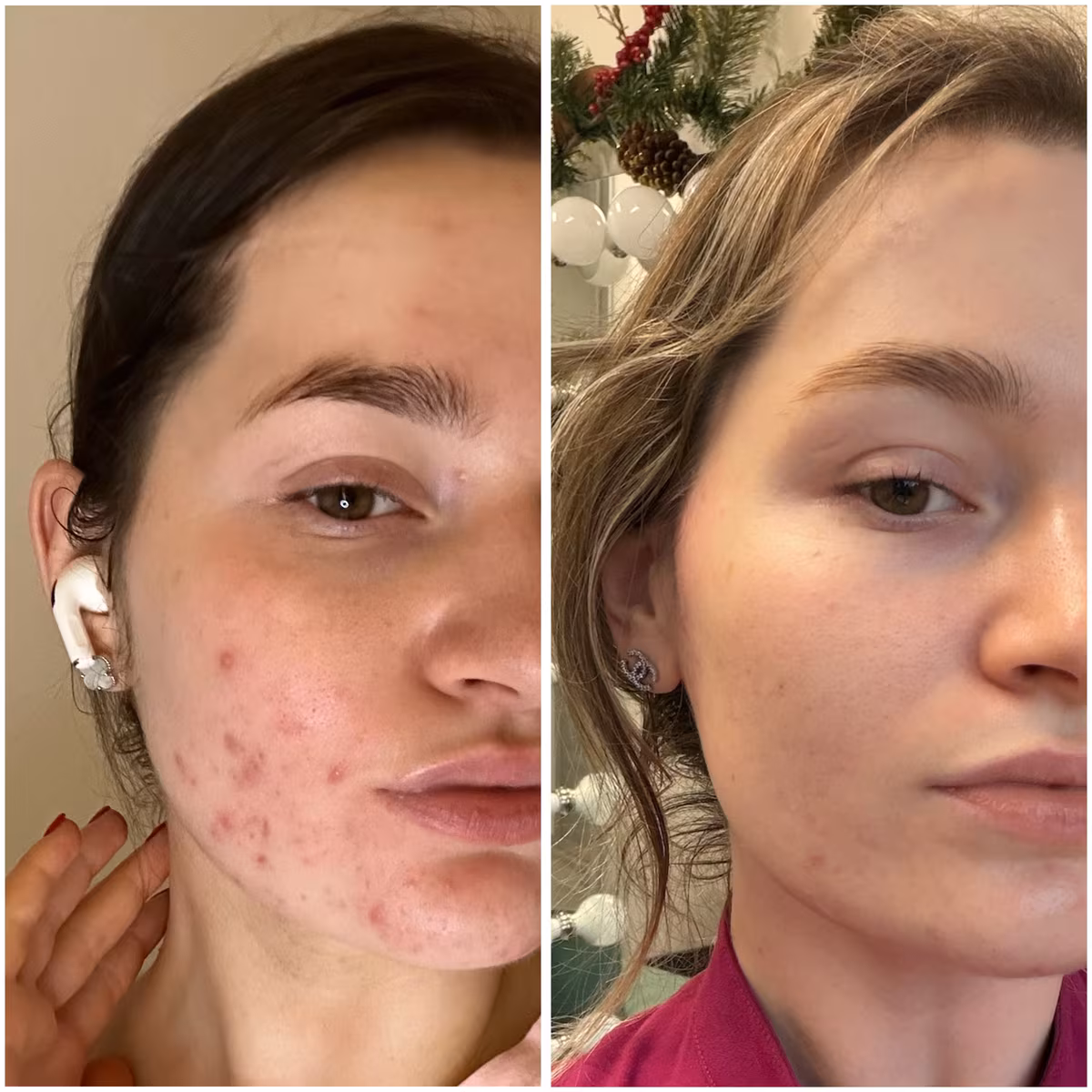 Carbon acne laser treatment before and after, inflamed breakouts on the cheek cleared to calm, even skin
