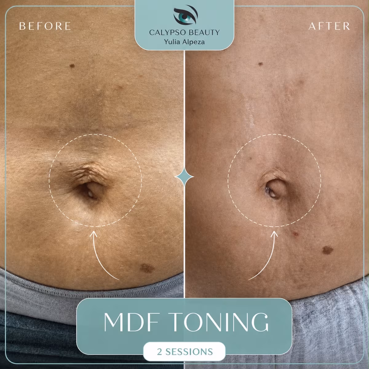 MDF laser toning before and after 2 sessions, smoother, firmer stomach skin around the navel
