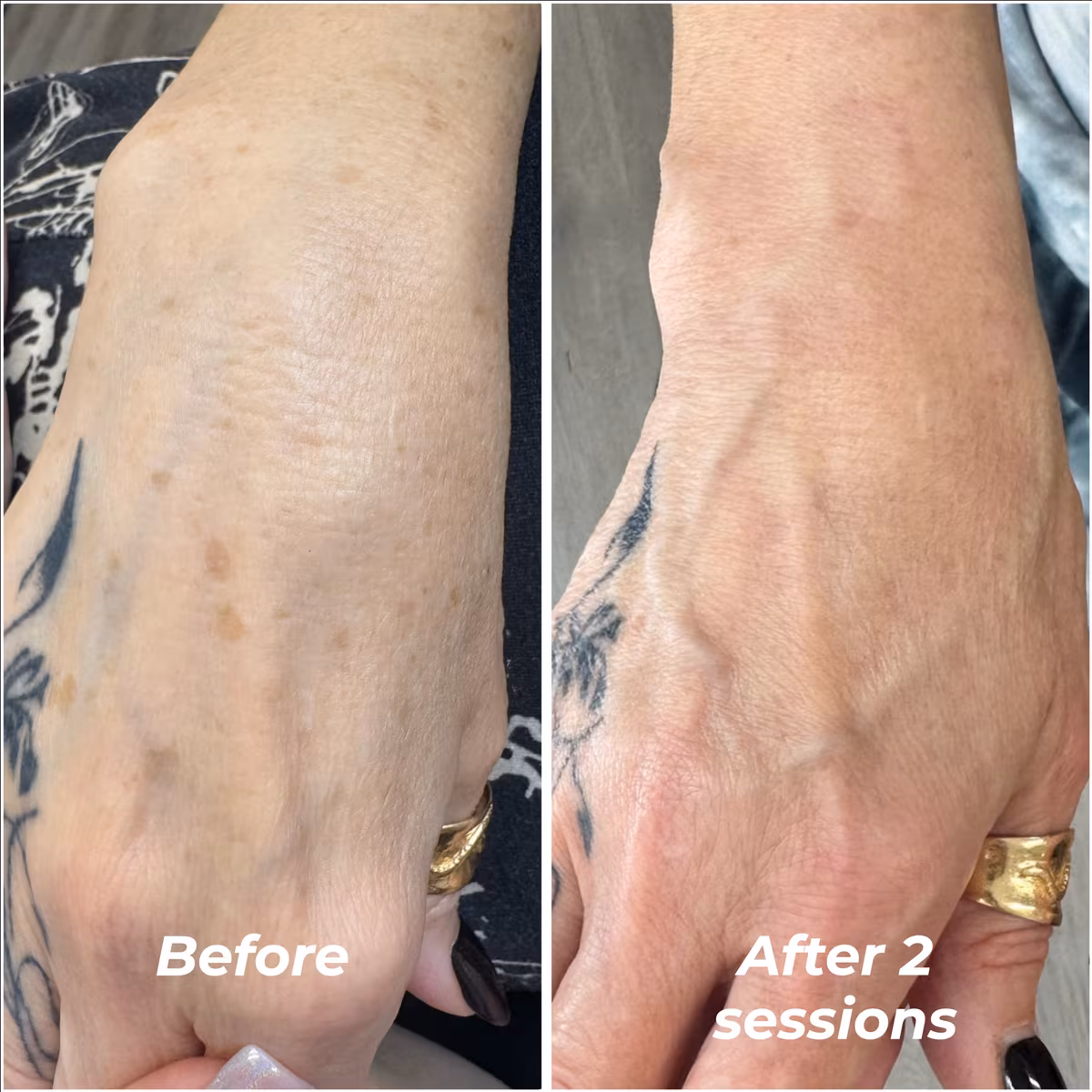 Laser pigment removal before and after 2 sessions, sun spots on the back of the hand cleared