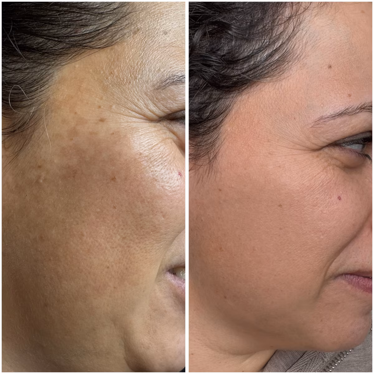 Hollywood Spectra laser toning before and after, melasma and sunspots visibly cleared on a client's cheek