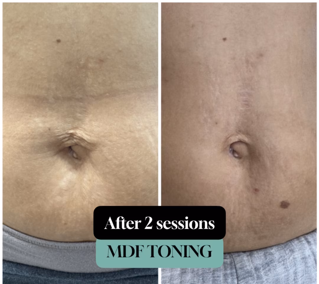 MDF Toning before and after 2 sessions: stomach with stretch marks (left) beside smoother, firmer skin (right)