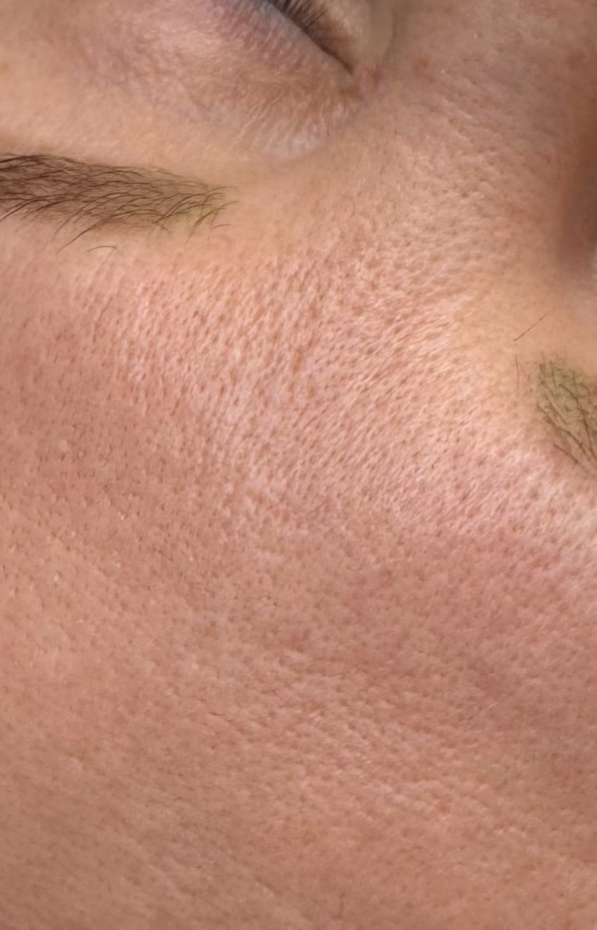 Smooth, even cheek and temple skin after MDF laser toning